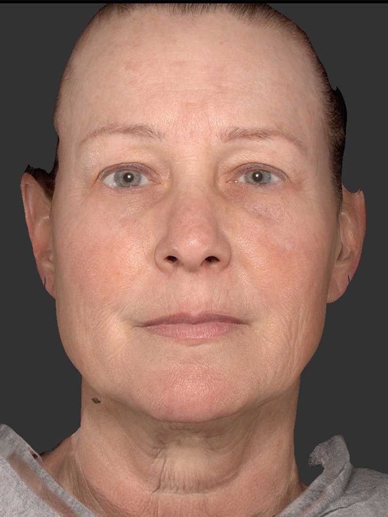AURI Sculpt & Restore Before & After Gallery - Patient 286828 - Image 1