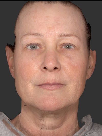 AURI Sculpt & Restore Before & After Gallery - Patient 286828 - Image 1