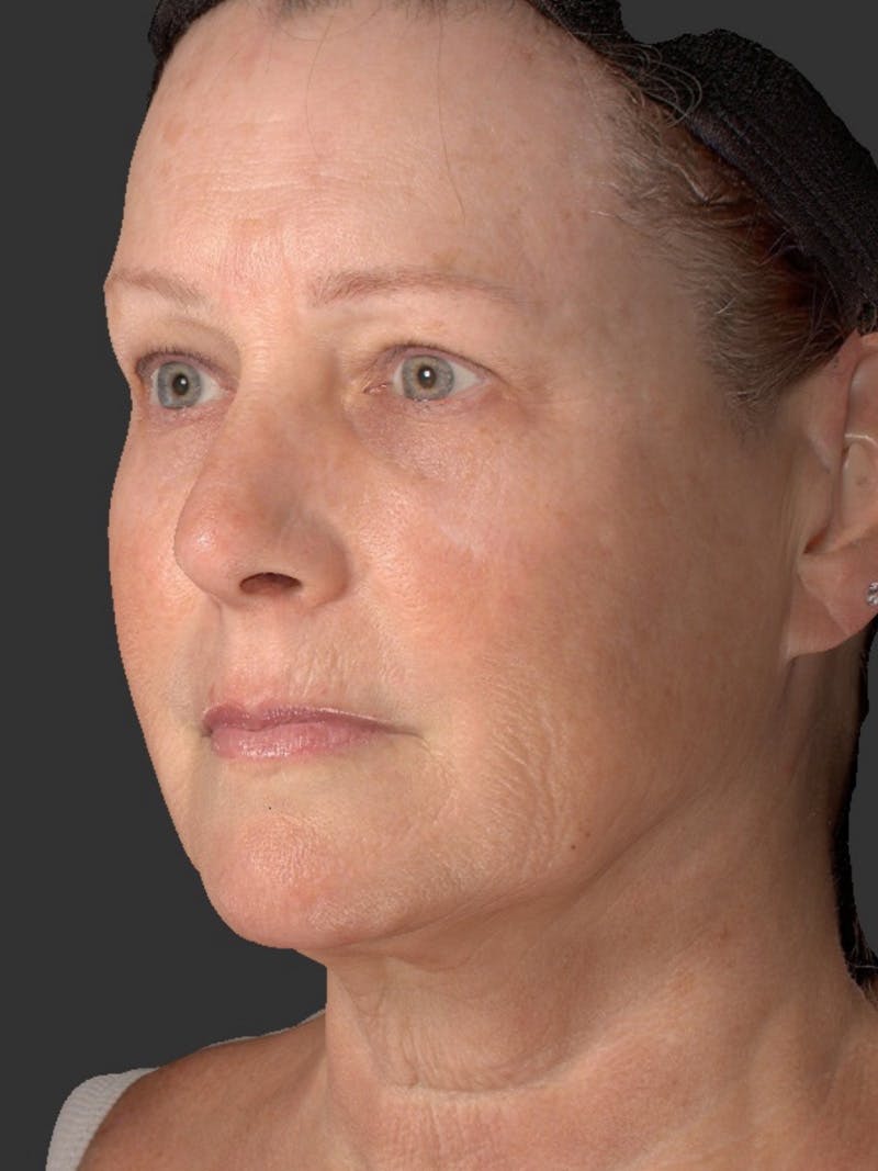 AURI Sculpt & Restore Before & After Gallery - Patient 286828 - Image 6