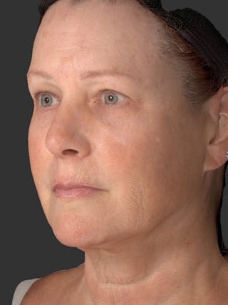 AURI Sculpt & Restore Before & After Gallery - Patient 286828 - Image 6