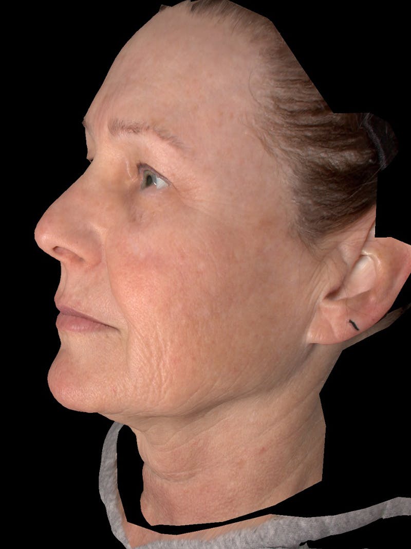 AURI Sculpt & Restore Before & After Gallery - Patient 286828 - Image 5