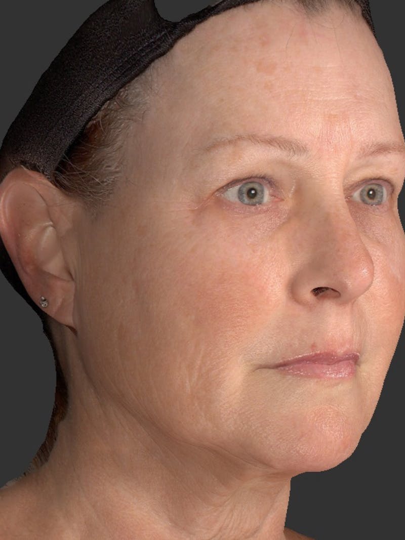 AURI Sculpt & Restore Before & After Gallery - Patient 286828 - Image 4