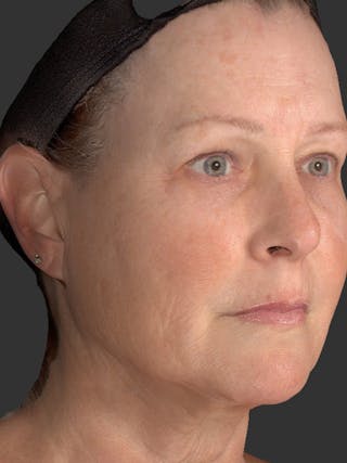 AURI Sculpt & Restore Before & After Gallery - Patient 286828 - Image 4