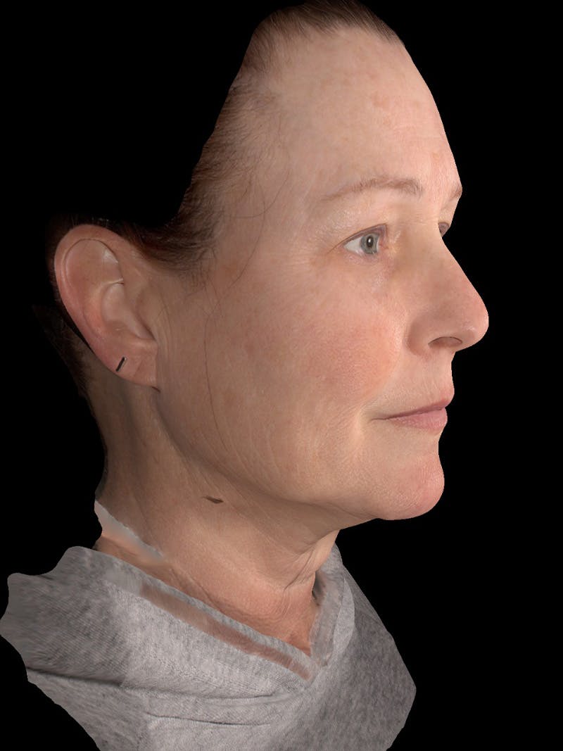 AURI Sculpt & Restore Before & After Gallery - Patient 286828 - Image 3