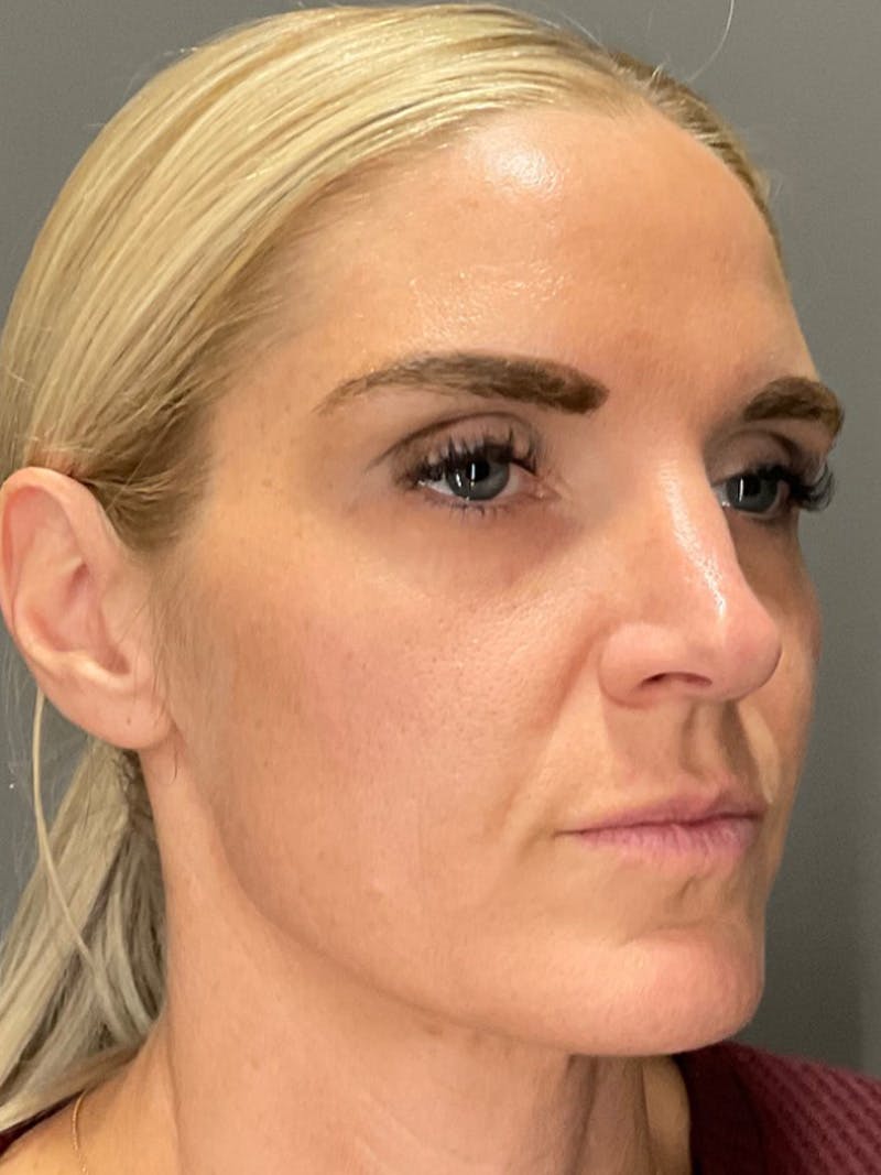 AURI Sculpt & Restore Before & After Gallery - Patient 225252 - Image 2