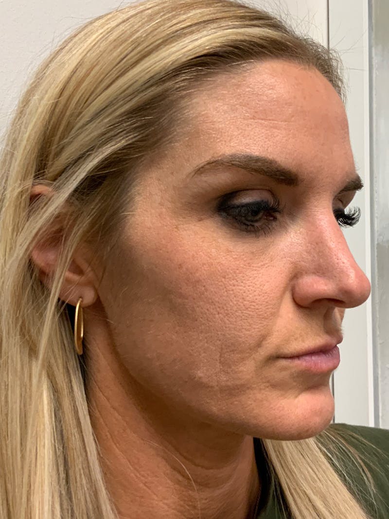 AURI Sculpt & Restore Before & After Gallery - Patient 225252 - Image 1
