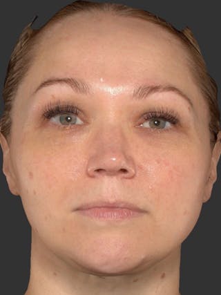 Microneedling Treatment Before & After Gallery - Patient 260621 - Image 2