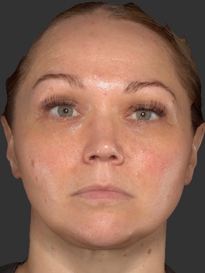Microneedling Treatment Before & After Gallery - Patient 260621 - Image 1