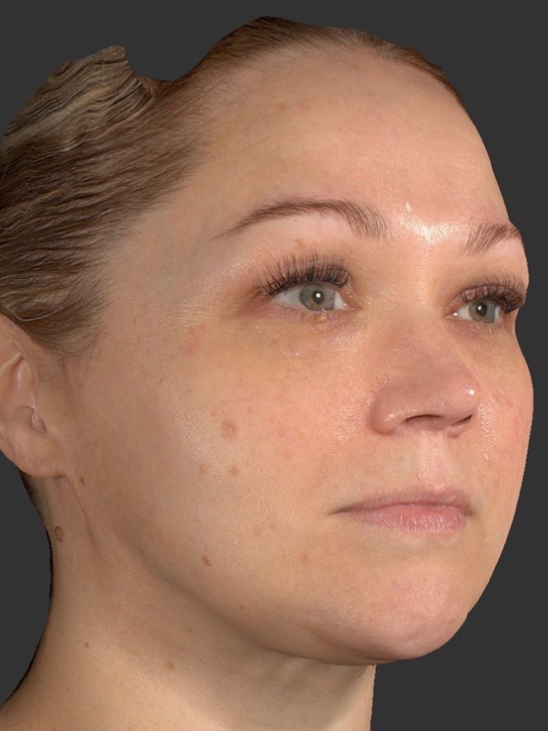 Microneedling Treatment Before & After Gallery - Patient 260621 - Image 4