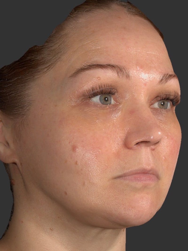 Microneedling Treatment Before & After Gallery - Patient 260621 - Image 3
