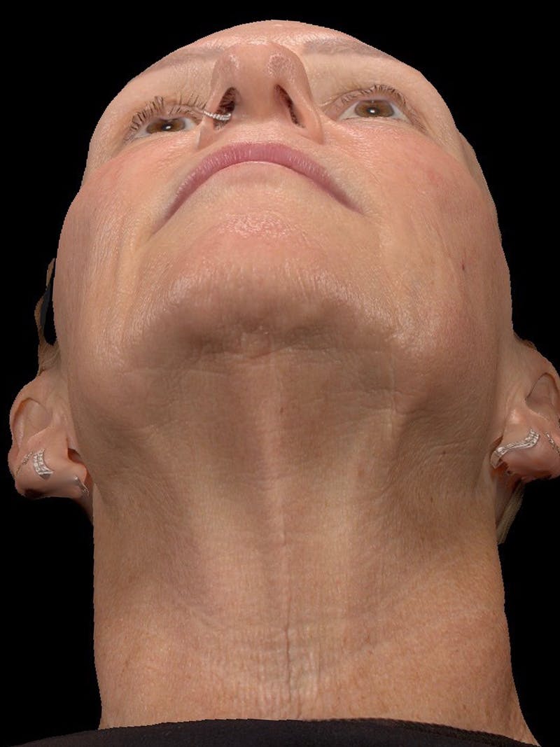 Microneedling Treatment Before & After Gallery - Patient 408916 - Image 2