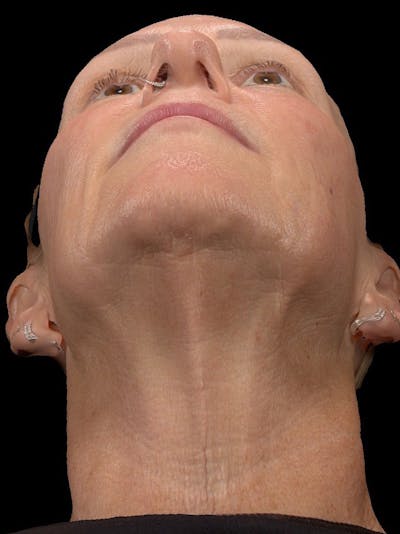 Microneedling Treatment Before & After Gallery - Patient 408916 - Image 2