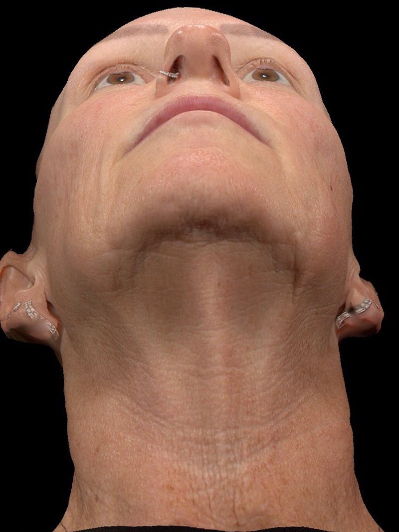 Microneedling Treatment Before & After Gallery - Patient 408916 - Image 1