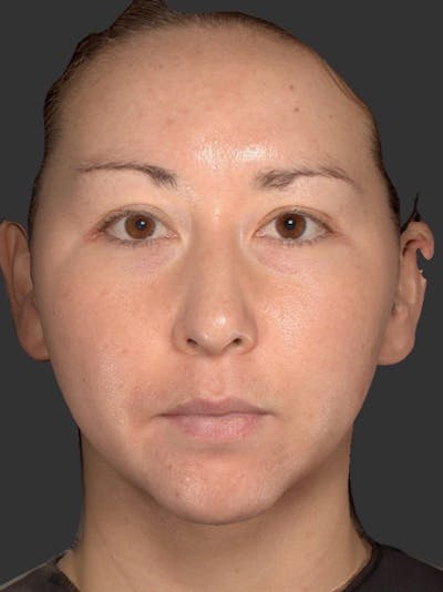 Microneedling Treatment Before & After Gallery - Patient 254213 - Image 2