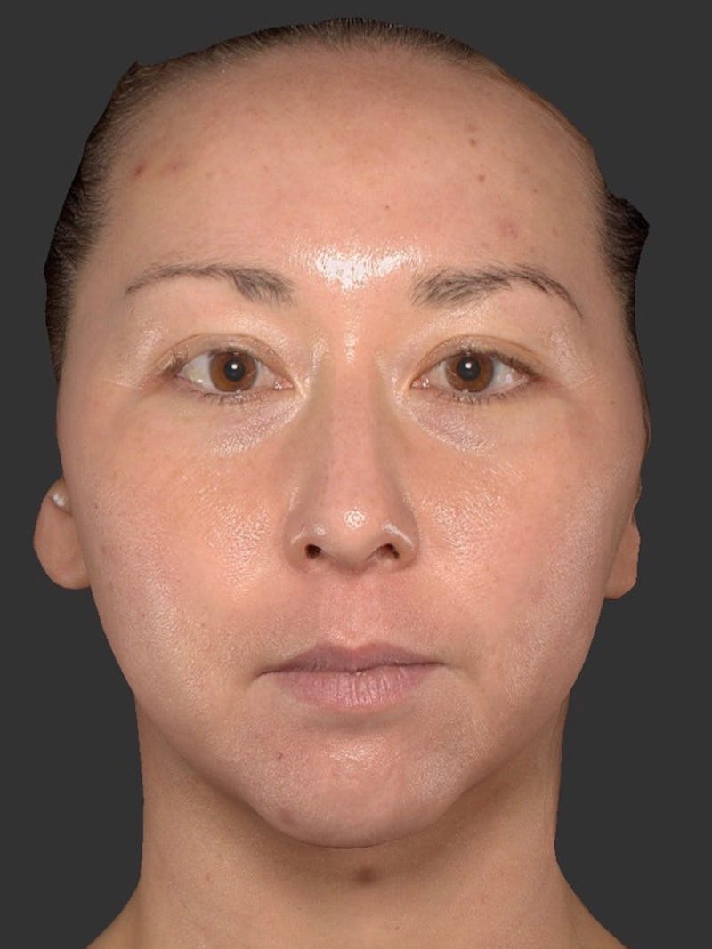 Microneedling Treatment Before & After Gallery - Patient 254213 - Image 1