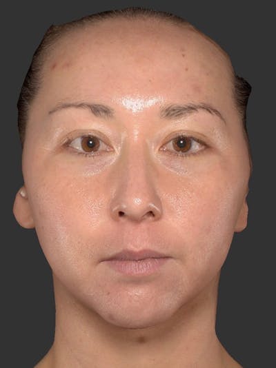 Microneedling Treatment Before & After Gallery - Patient 254213 - Image 1