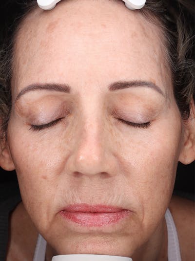 Laser Treatment Before & After Gallery - Patient 276675 - Image 1