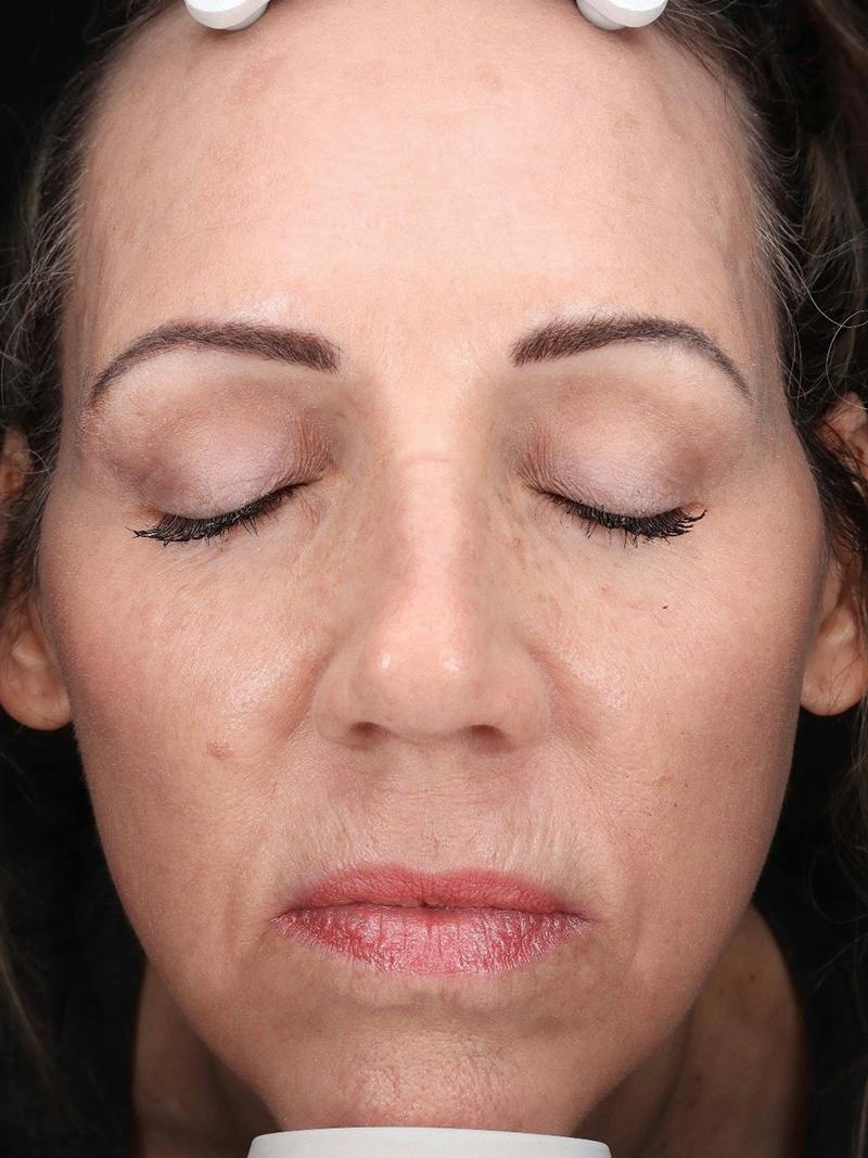 Laser Treatment Before & After Gallery - Patient 276675 - Image 2
