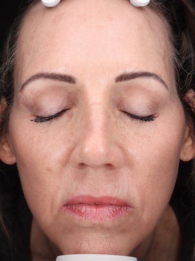 Laser Treatment Before & After Gallery - Patient 276675 - Image 2