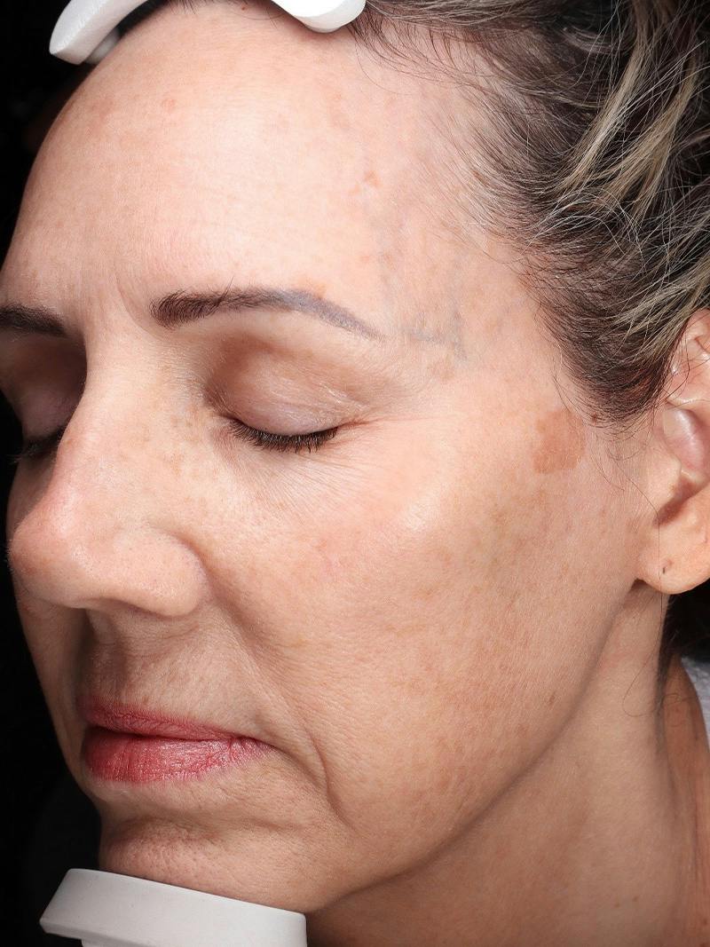 Laser Treatment Before & After Gallery - Patient 276675 - Image 5