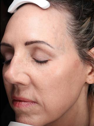 Laser Treatment Before & After Gallery - Patient 276675 - Image 6