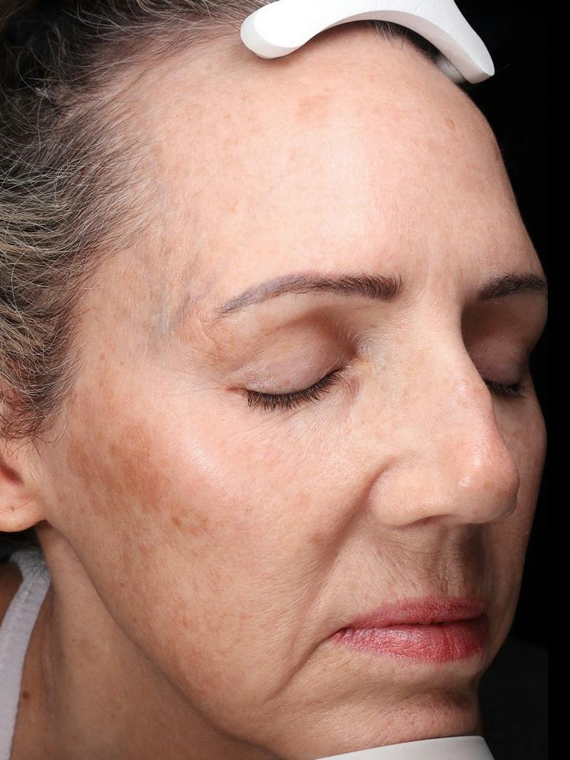 Laser Treatment Before & After Gallery - Patient 276675 - Image 3