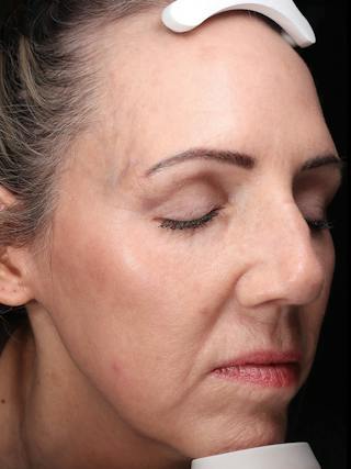 Laser Treatment Before & After Gallery - Patient 276675 - Image 4
