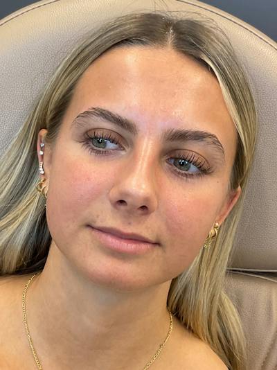 Lip Filler Before & After Gallery - Patient 198977 - Image 1