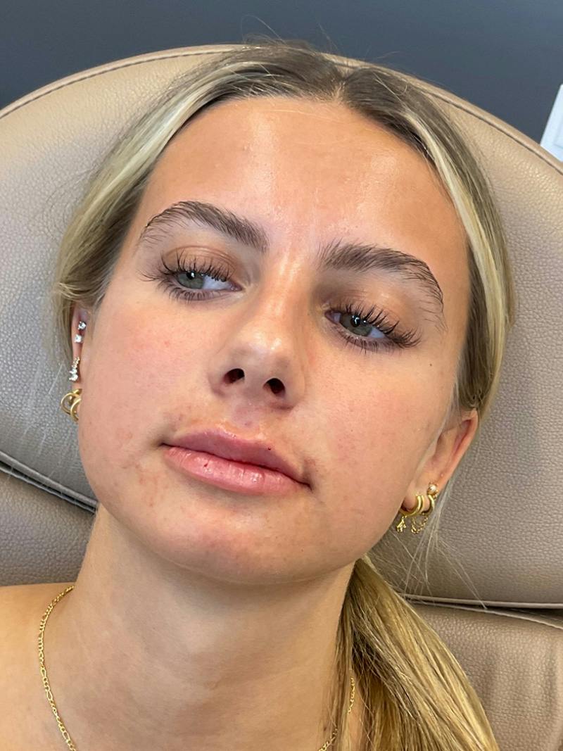 Lip Filler Before & After Gallery - Patient 198977 - Image 2