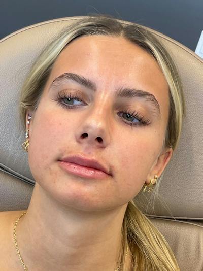 Lip Filler Before & After Gallery - Patient 198977 - Image 2
