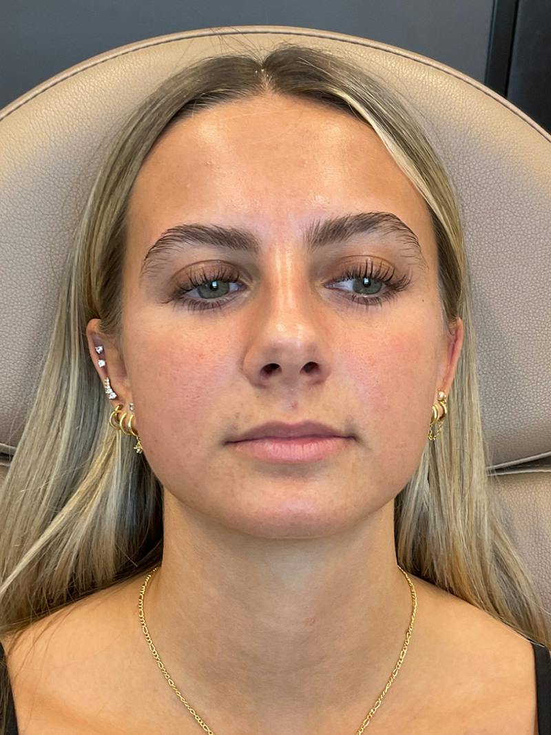 Lip Filler Before & After Gallery - Patient 198977 - Image 3