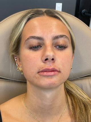 Lip Filler Before & After Gallery - Patient 198977 - Image 4