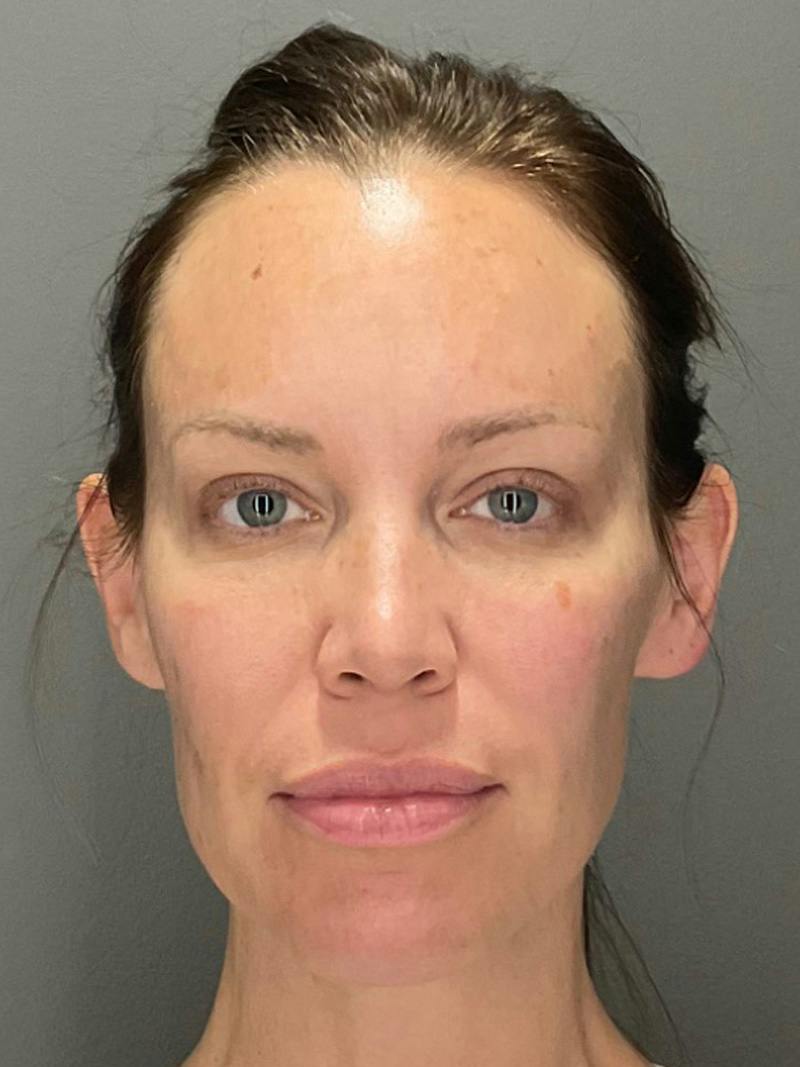Full Face Rejuvenation Before & After Gallery - Patient 251593 - Image 1