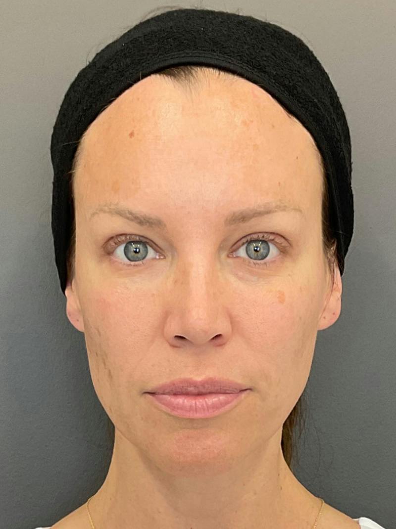 Full Face Rejuvenation Before & After Gallery - Patient 251593 - Image 2