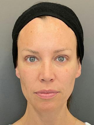 Full Face Rejuvenation Before & After Gallery - Patient 251593 - Image 2