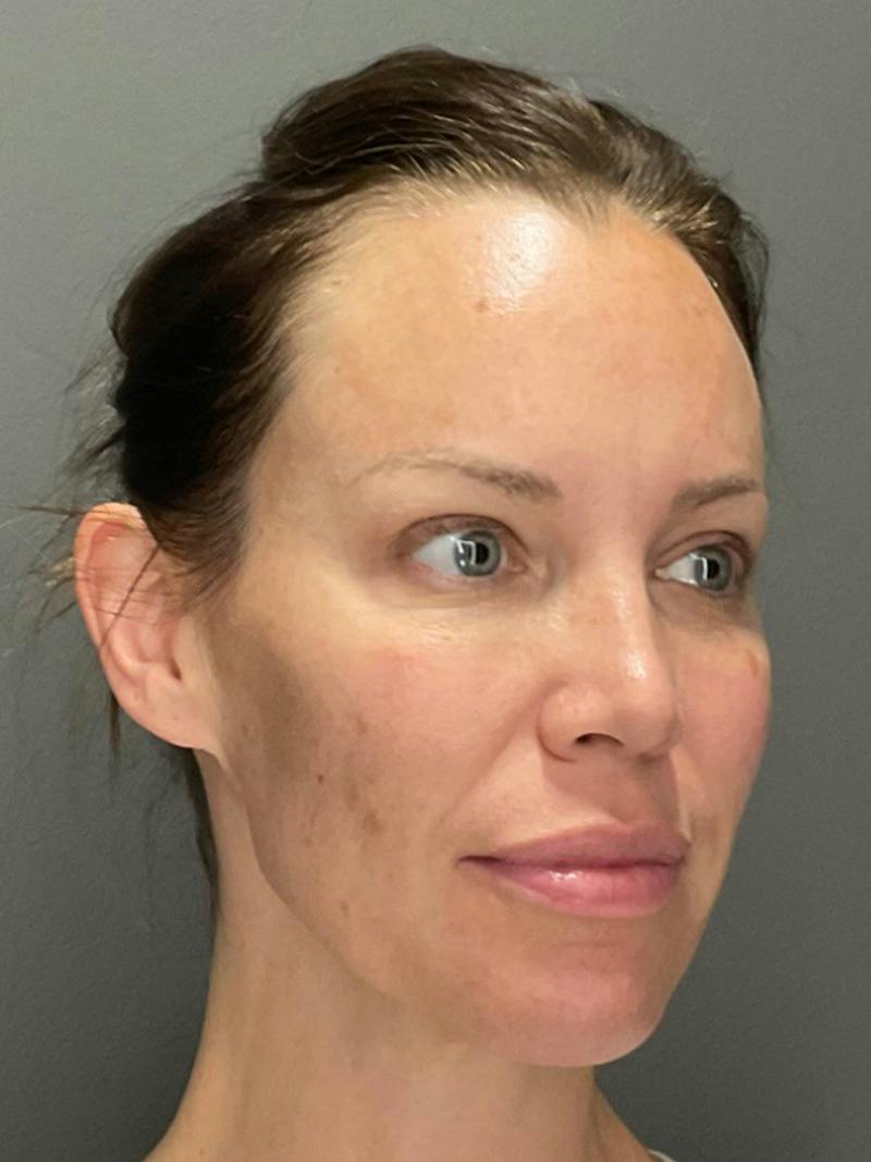 Full Face Rejuvenation Before & After Gallery - Patient 251593 - Image 3