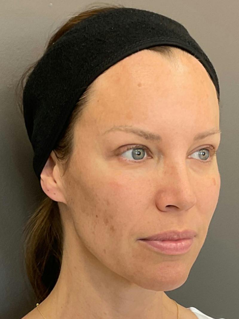 Full Face Rejuvenation Before & After Gallery - Patient 251593 - Image 4