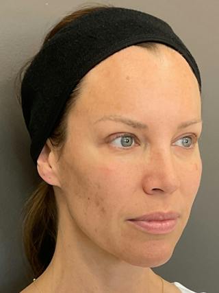 Full Face Rejuvenation Before & After Gallery - Patient 251593 - Image 4