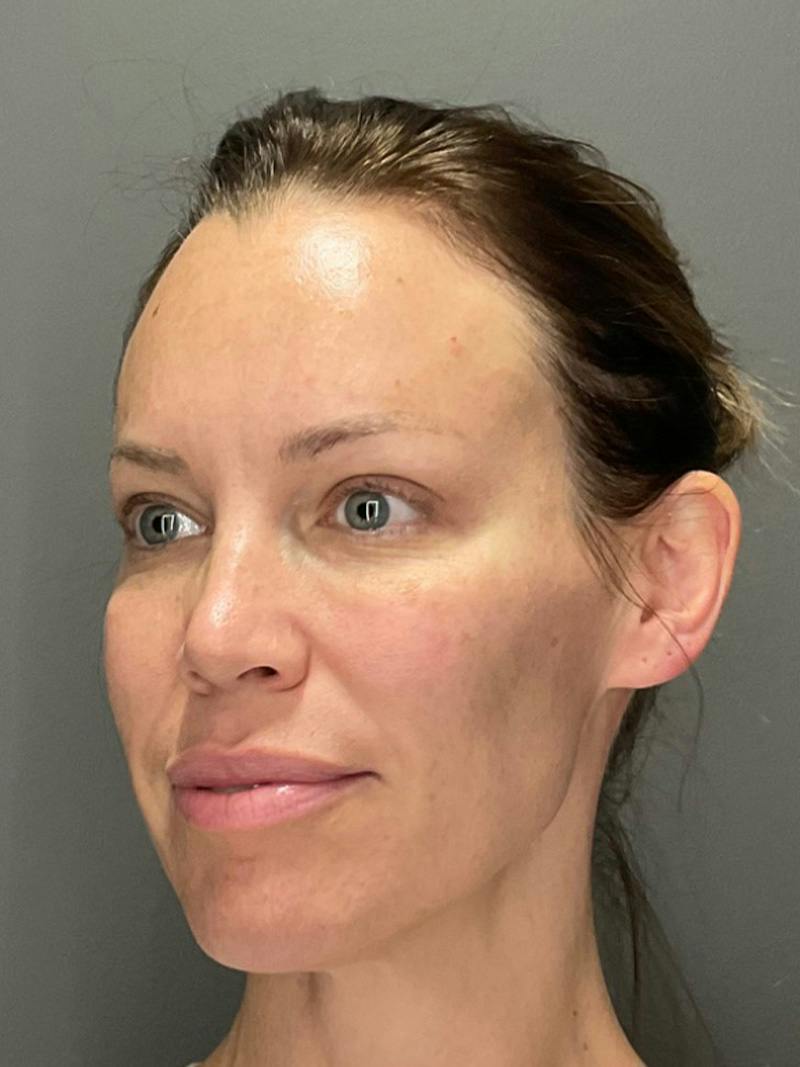 Full Face Rejuvenation Before & After Gallery - Patient 251593 - Image 5