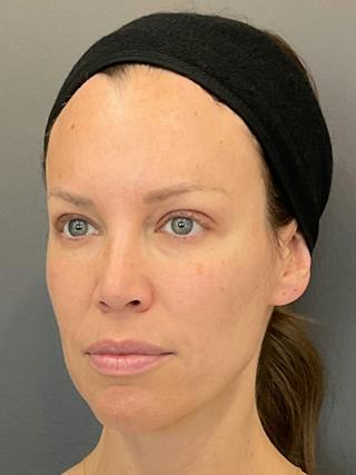 Full Face Rejuvenation Before & After Gallery - Patient 251593 - Image 6