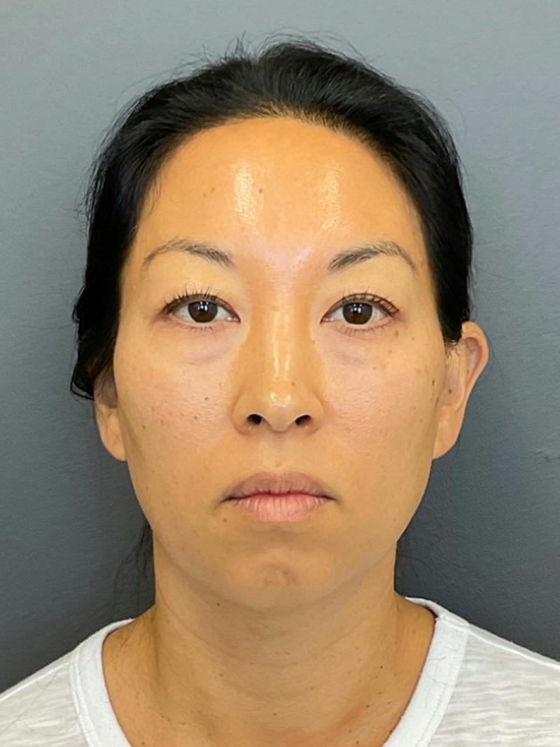 Chin Filler Before & After Gallery - Patient 398156 - Image 1