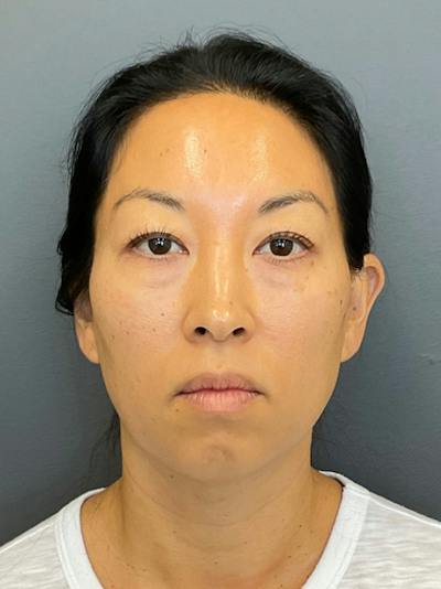 Chin Filler Before & After Gallery - Patient 398156 - Image 1
