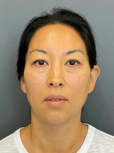 Chin Filler Before & After Gallery - Patient 398156 - Image 2