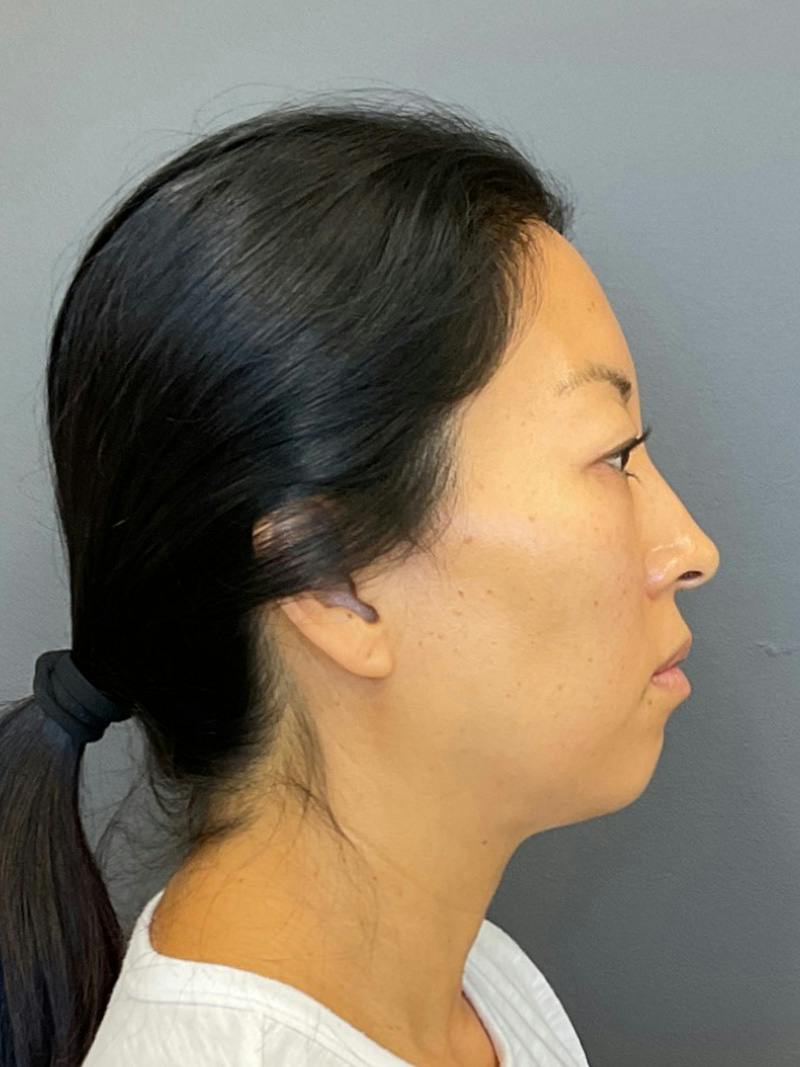 Chin Filler Before & After Gallery - Patient 398156 - Image 3