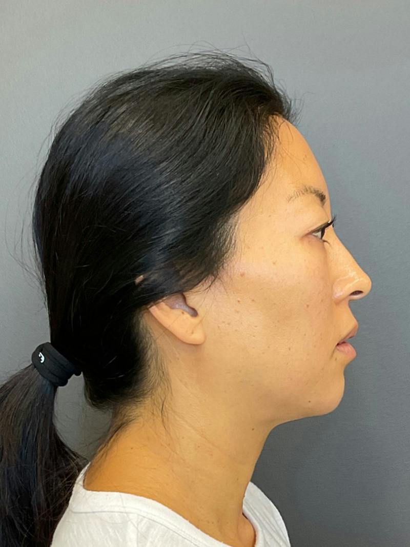 Chin Filler Before & After Gallery - Patient 398156 - Image 4