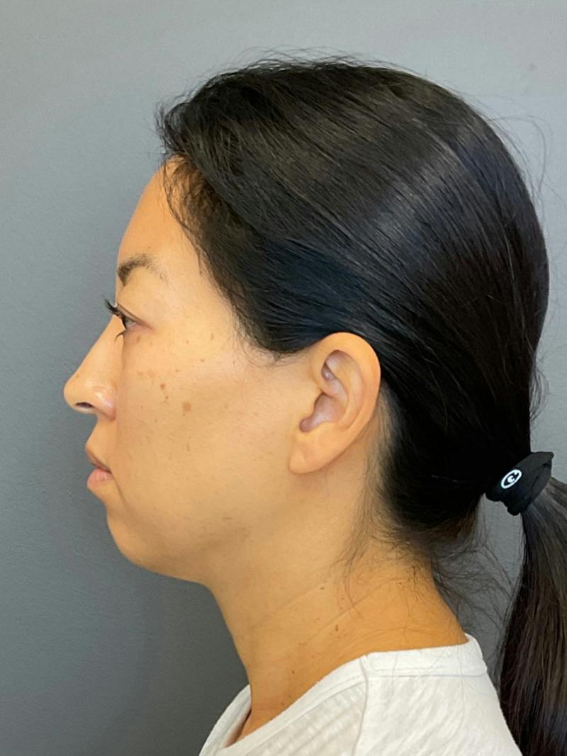 Chin Filler Before & After Gallery - Patient 398156 - Image 5