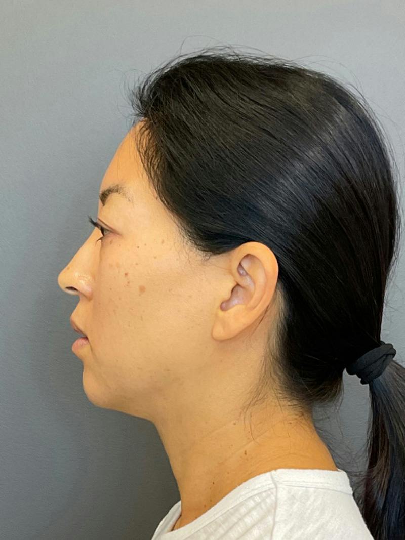 Chin Filler Before & After Gallery - Patient 398156 - Image 6