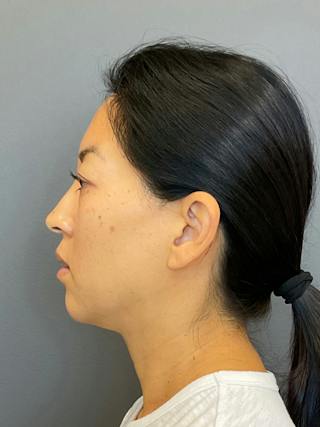 Chin Filler Before & After Gallery - Patient 398156 - Image 6