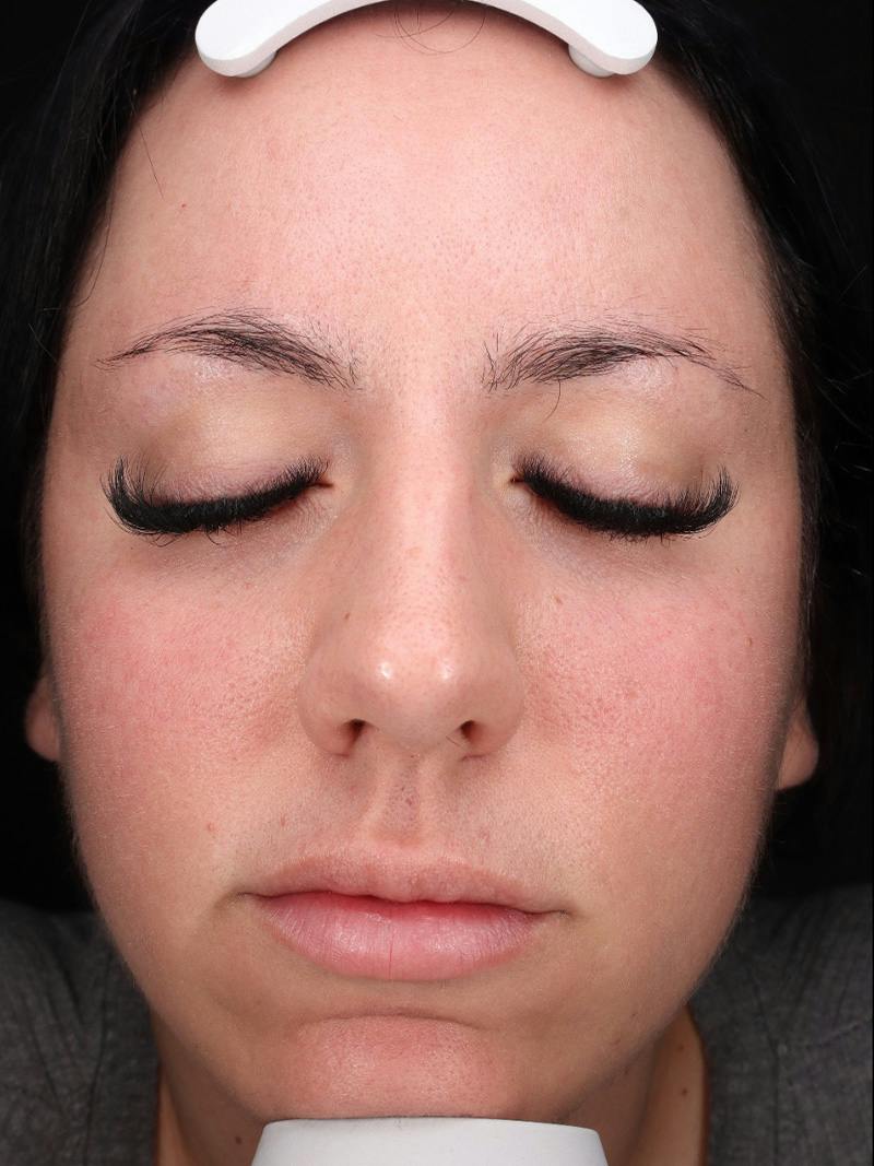 Skin Care Protocol Before & After Gallery - Patient 145945 - Image 1