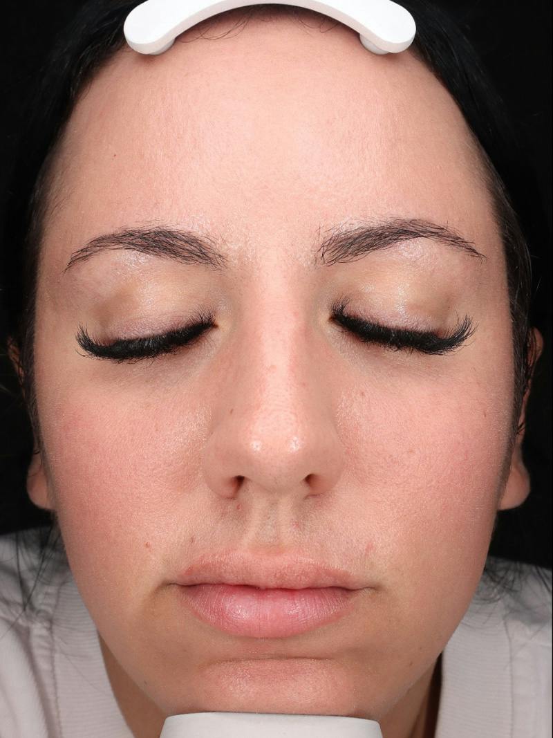 Skin Care Protocol Before & After Gallery - Patient 145945 - Image 2